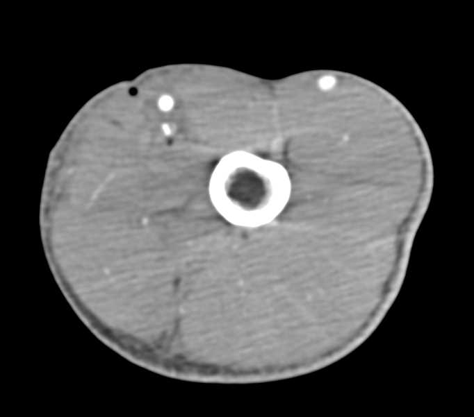 Trauma with Intact Vascular Map - CTisus CT Scan