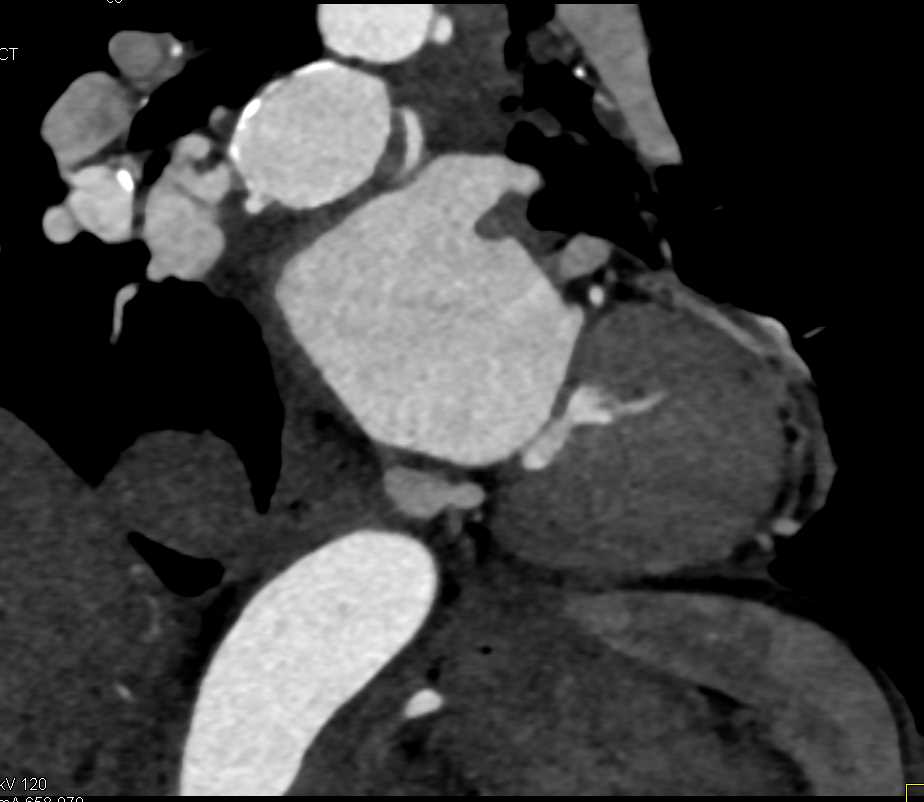 Bronchial Artery Aneurysms - CTisus CT Scan