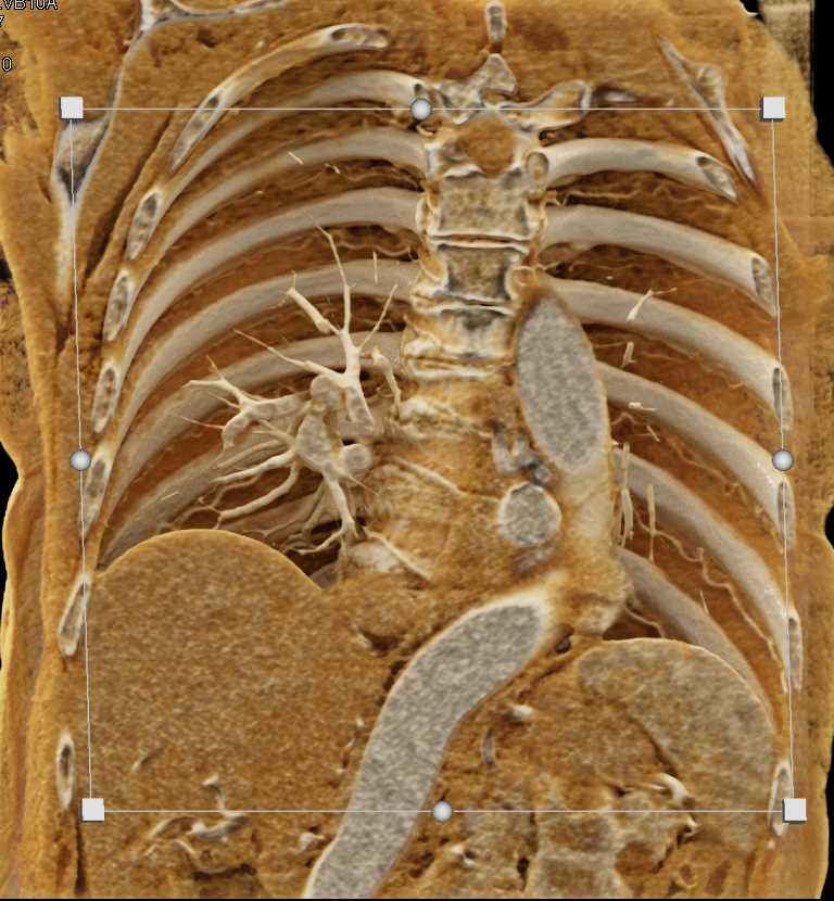 Multiple Bronchial Artery Aneurysms with Cinematic Rendering - CTisus CT Scan