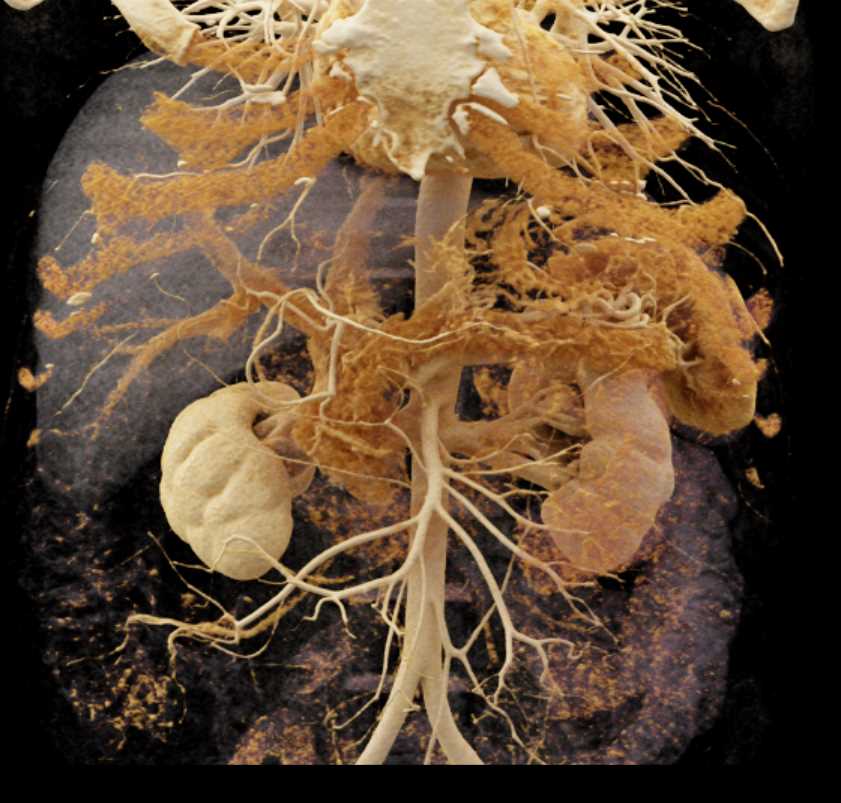 Mesenteric Vascular Arcade - CTisus CT Scan