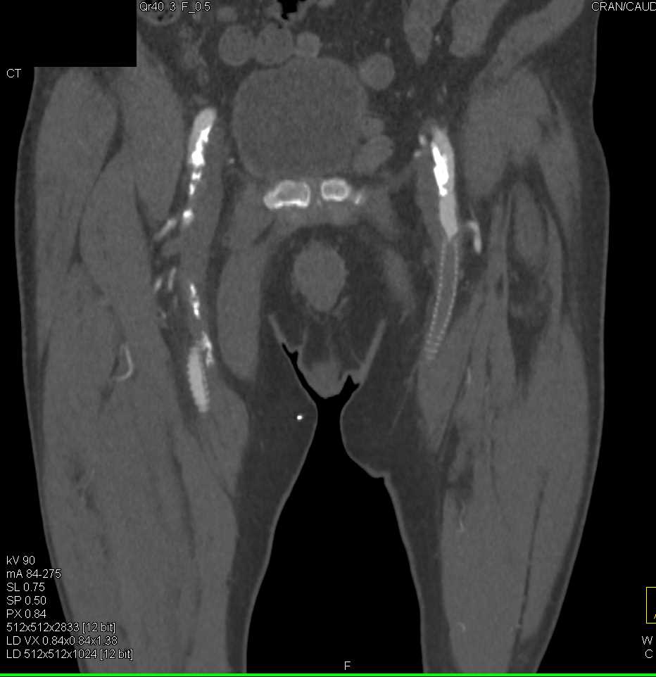 Peripheral Vascular Disease (PVD) with Extensive Vascular Disease - CTisus CT Scan