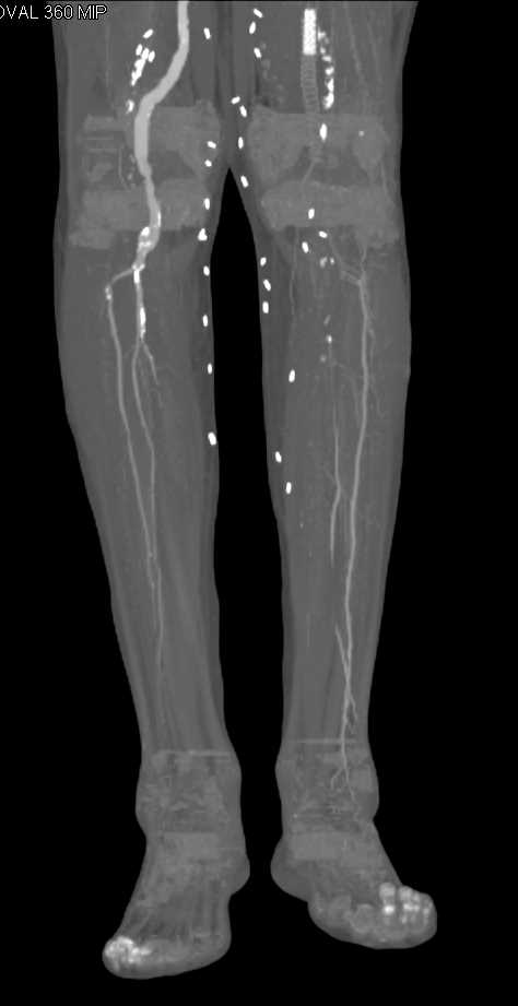 Severe Peripheral Vascular Disease - CTisus CT Scan