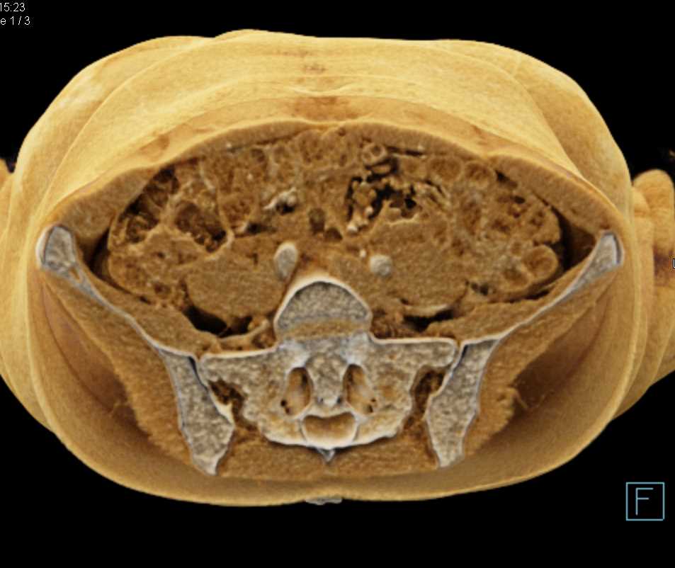 Cinematic Rendering of the Aorta - CTisus CT Scan