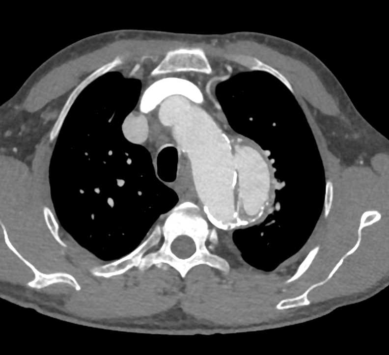 Type B Aortic Dissection - CTisus CT Scan