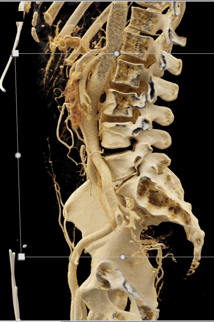 Mesenteric Arcade with Cinematic Rendering - CTisus CT Scan