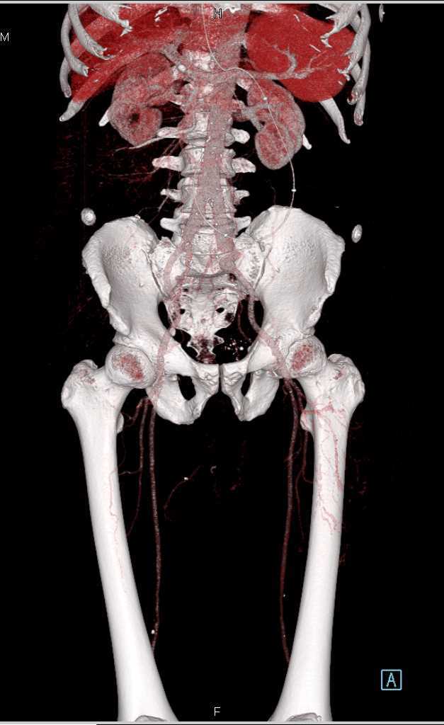 Left Common Iliac Artery Aneurysm with Bleed - CTisus CT Scan