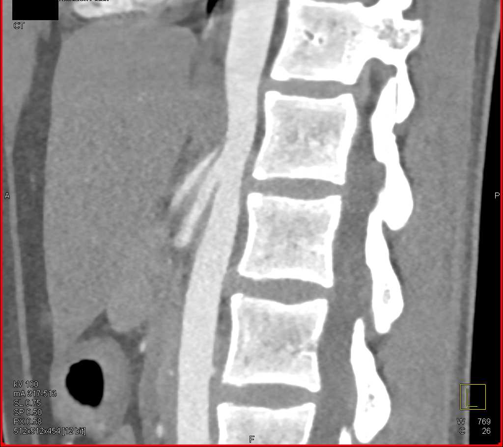 Stenosis Celiac Artery due to Median Arcuate Ligament - CTisus CT Scan