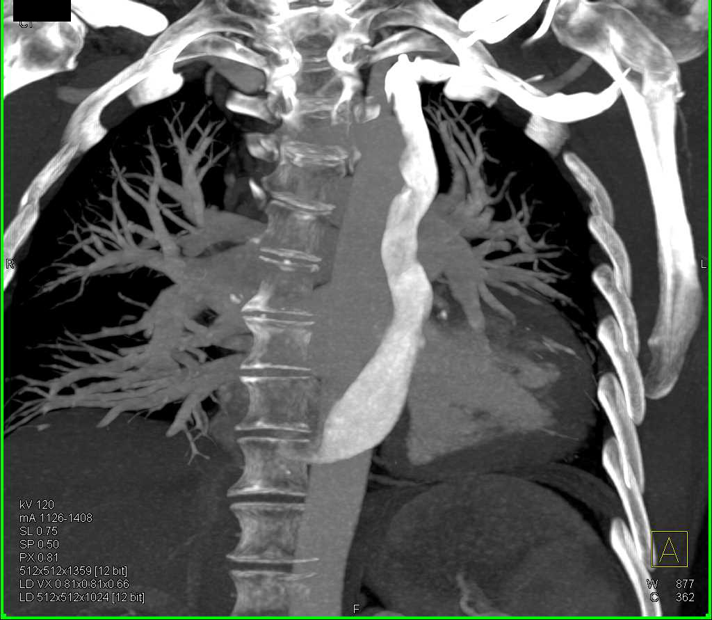 Persistent Left Superior Vena Cava (SVC) - CTisus CT Scan