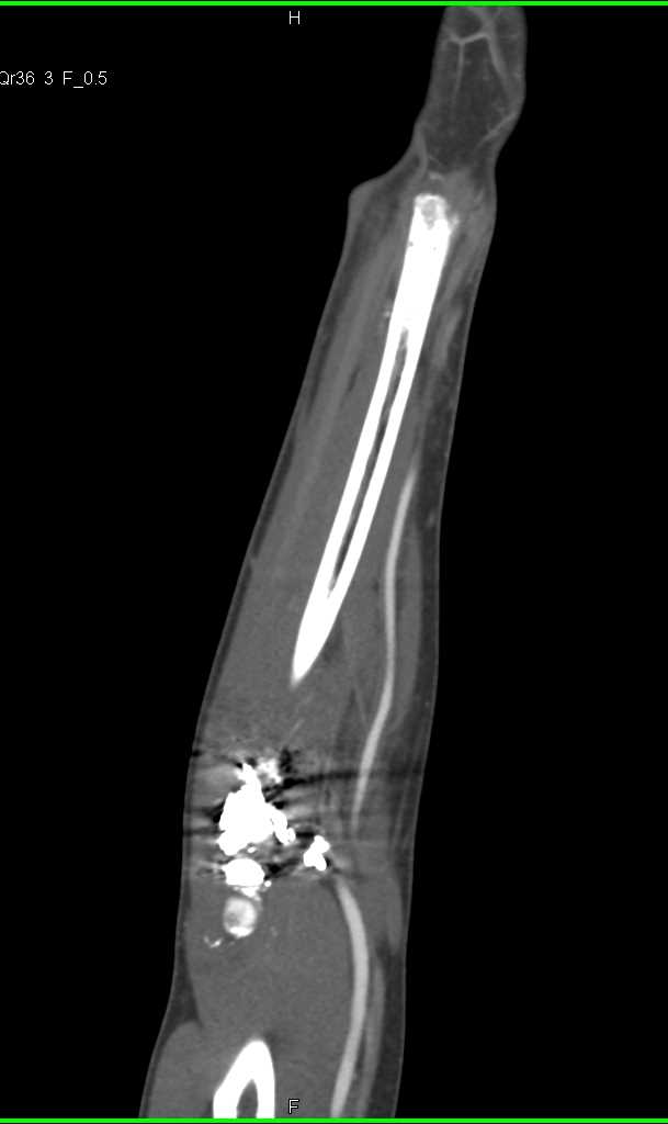 Surgical Repair Elbow but vessel runoff was Normal - CTisus CT Scan