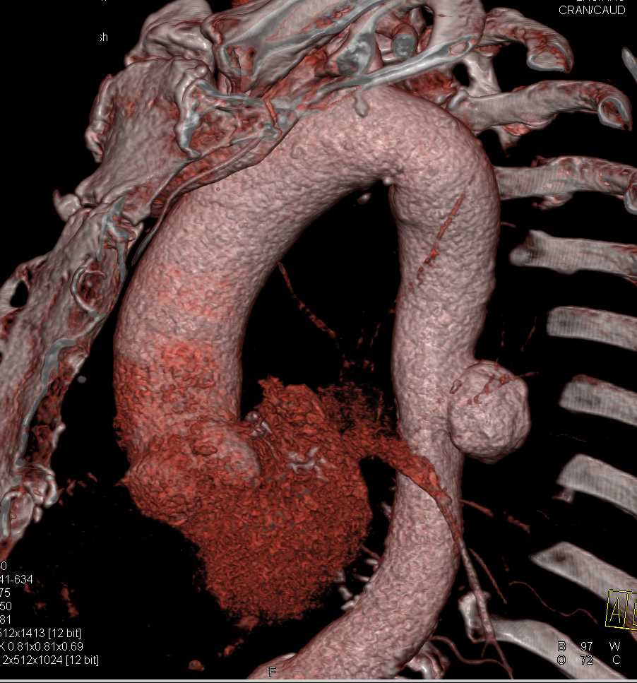 Ulceration with Intramural Hematoma Descending Thoracic Aorta - CTisus CT Scan