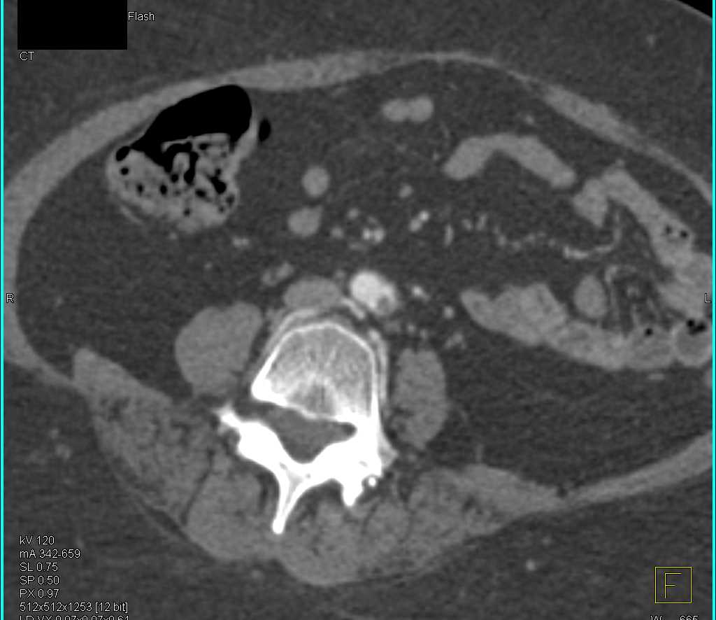 Multiple Arterial Clots on Left Including the Common Iliac Artery - CTisus CT Scan