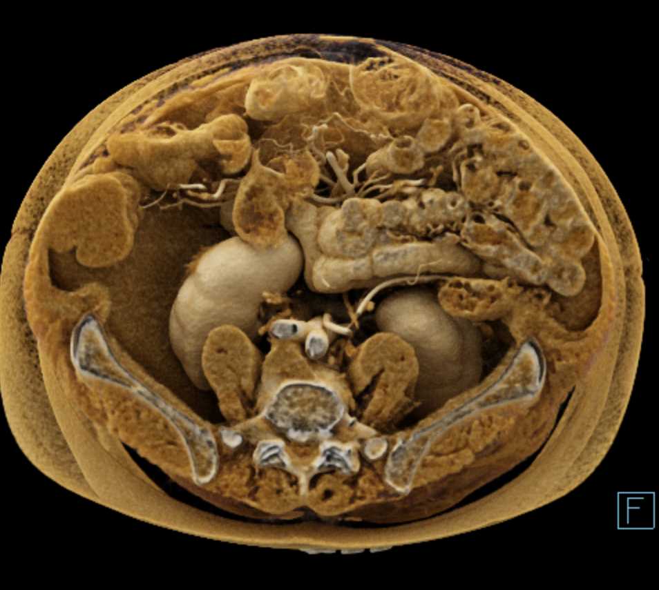 Vascular Mapping of the Aorta and Branching with Cinematic Rendering - CTisus CT Scan