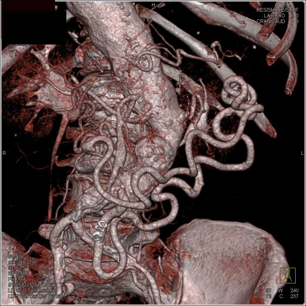 Aortic Aneurysm with Superior Mesenteric Artery (SMA) and Celiac Occlusion - CTisus CT Scan