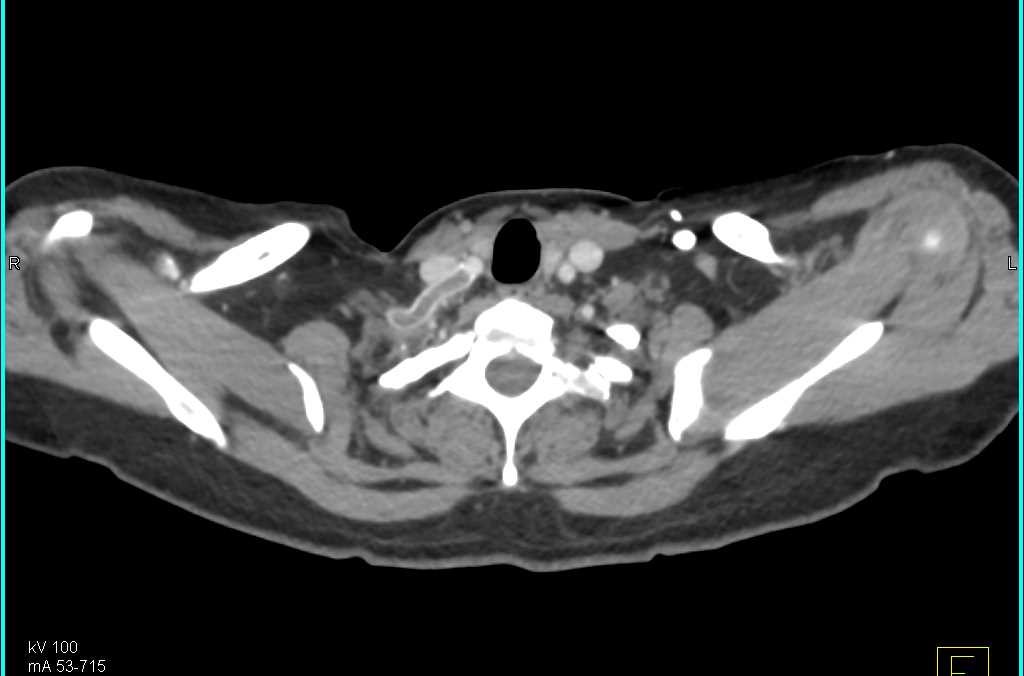 Occluded Stent to the Right Carotid Artery - CTisus CT Scan