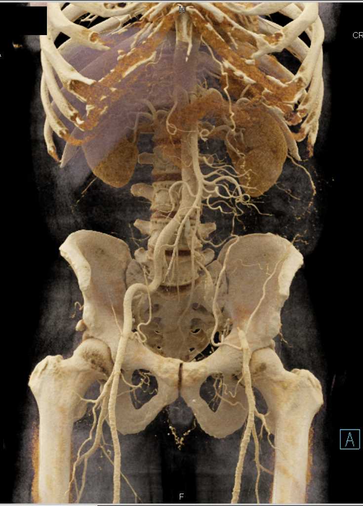 Occlusion of the Left Common Iliac Artery with Cinematic Rendering - CTisus CT Scan