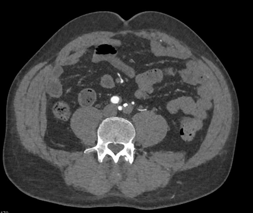 Stenosis Left Common Iliac Artery - CTisus CT Scan