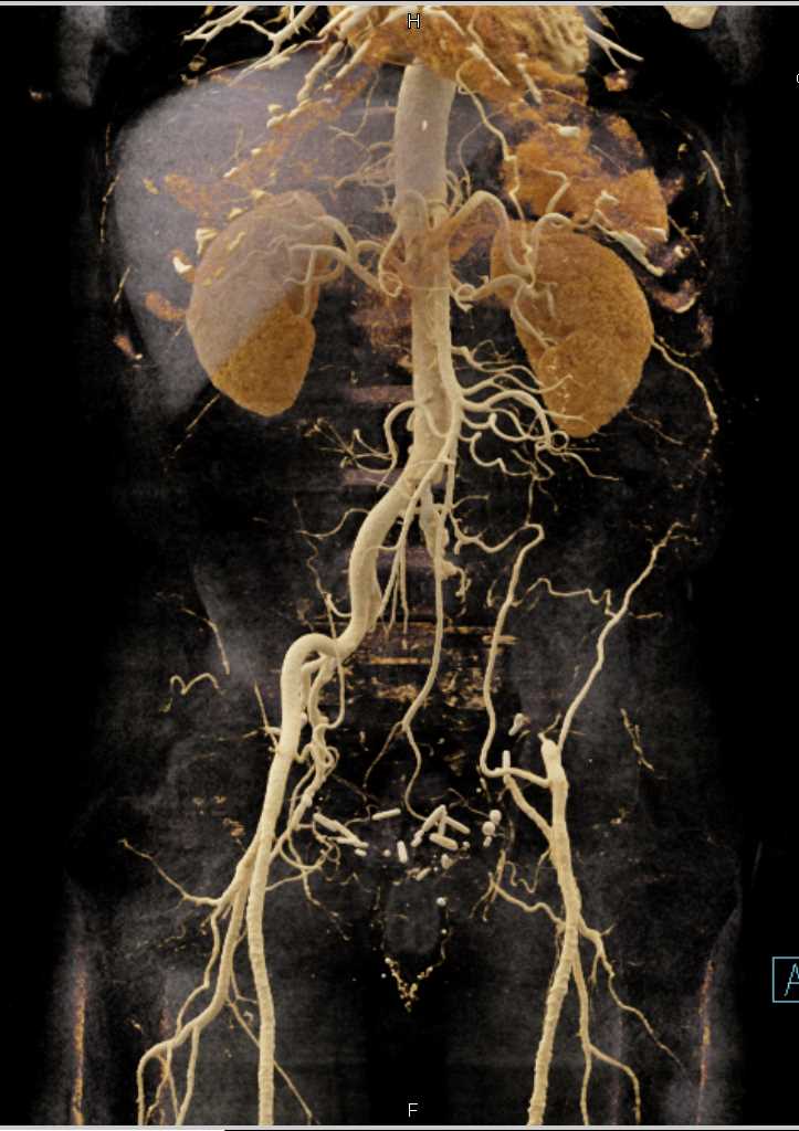 Occlusion Left Common Iliac Artery - CTisus CT Scan