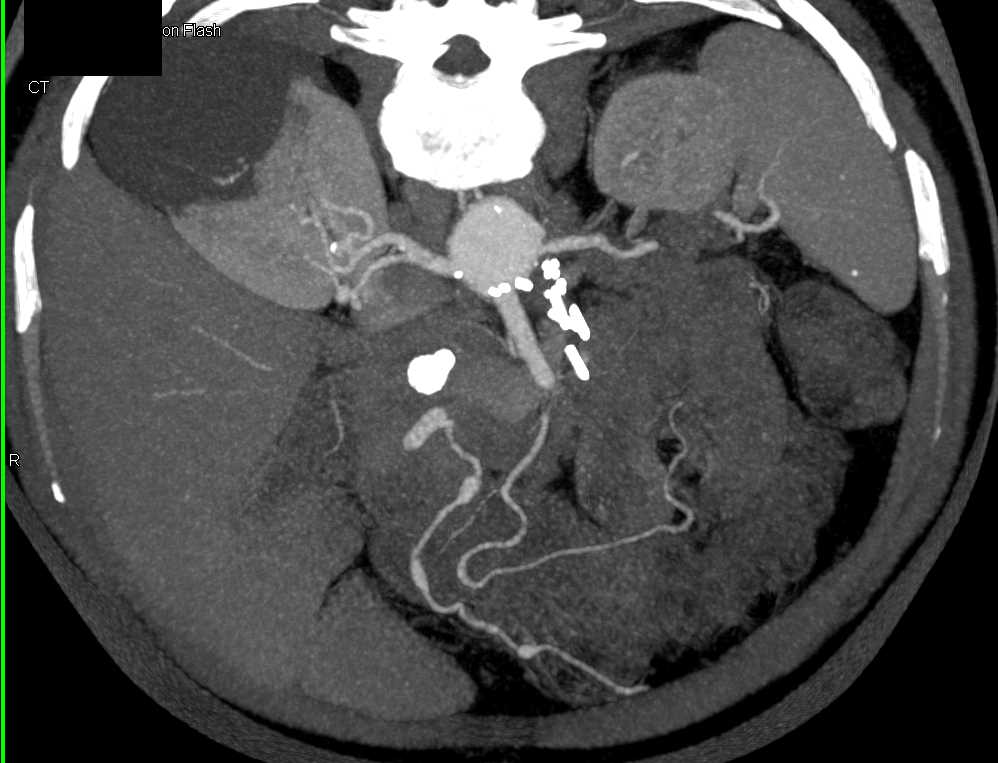 Multiple Superior Mesenteric Artery (SMA) Aneurysms - Vascular Case ...