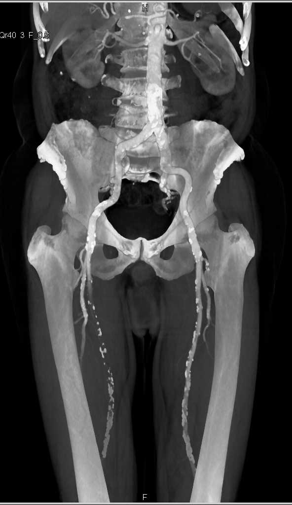 Peripheral Vascular Disease (PVD) with Multiple Plaques and Stenosis - CTisus CT Scan