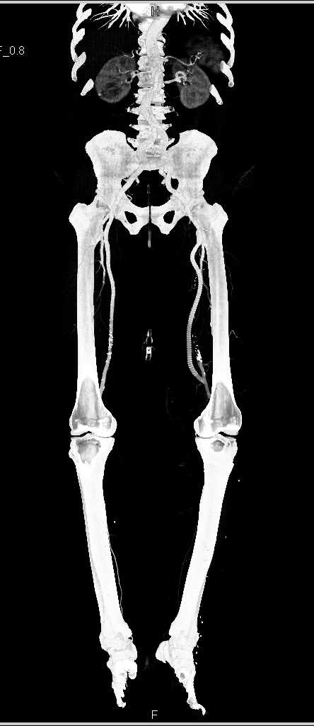 Vascular Grafting on Left Side with Patent Graft - CTisus CT Scan