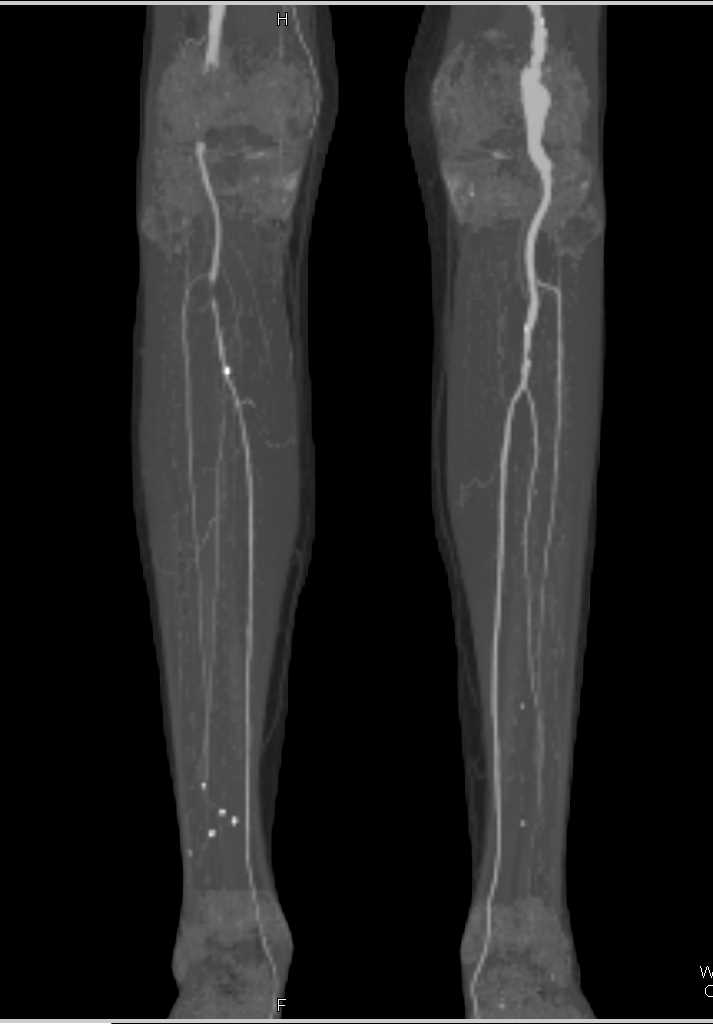 Aneurysmal Dilatation of the Left Popliteal Artery - CTisus CT Scan