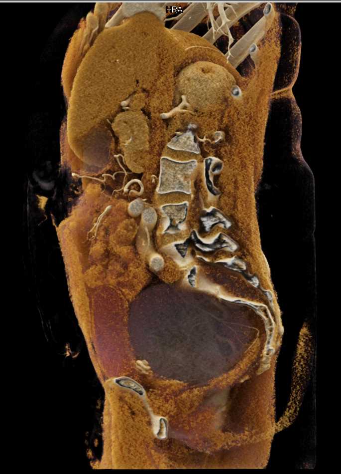 Dural Ectasia Sacrum in Marfans Syndrome - CTisus CT Scan