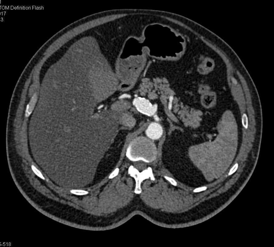 Celiac Artery Aneurysm - CTisus CT Scan