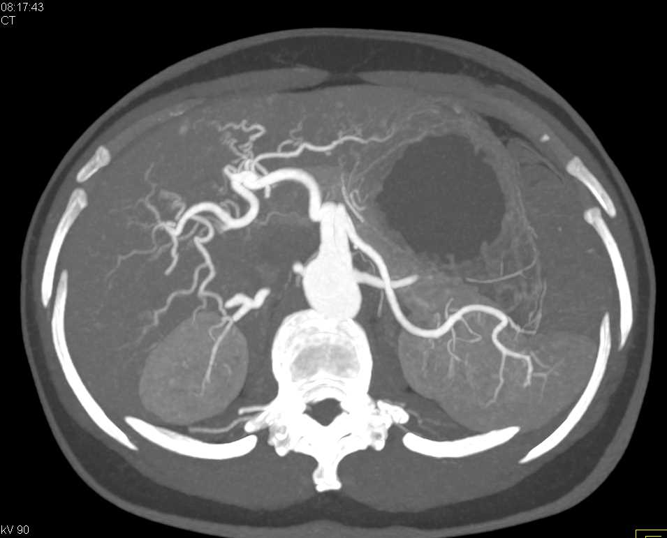 Hepatic Artery Branching - CTisus CT Scan