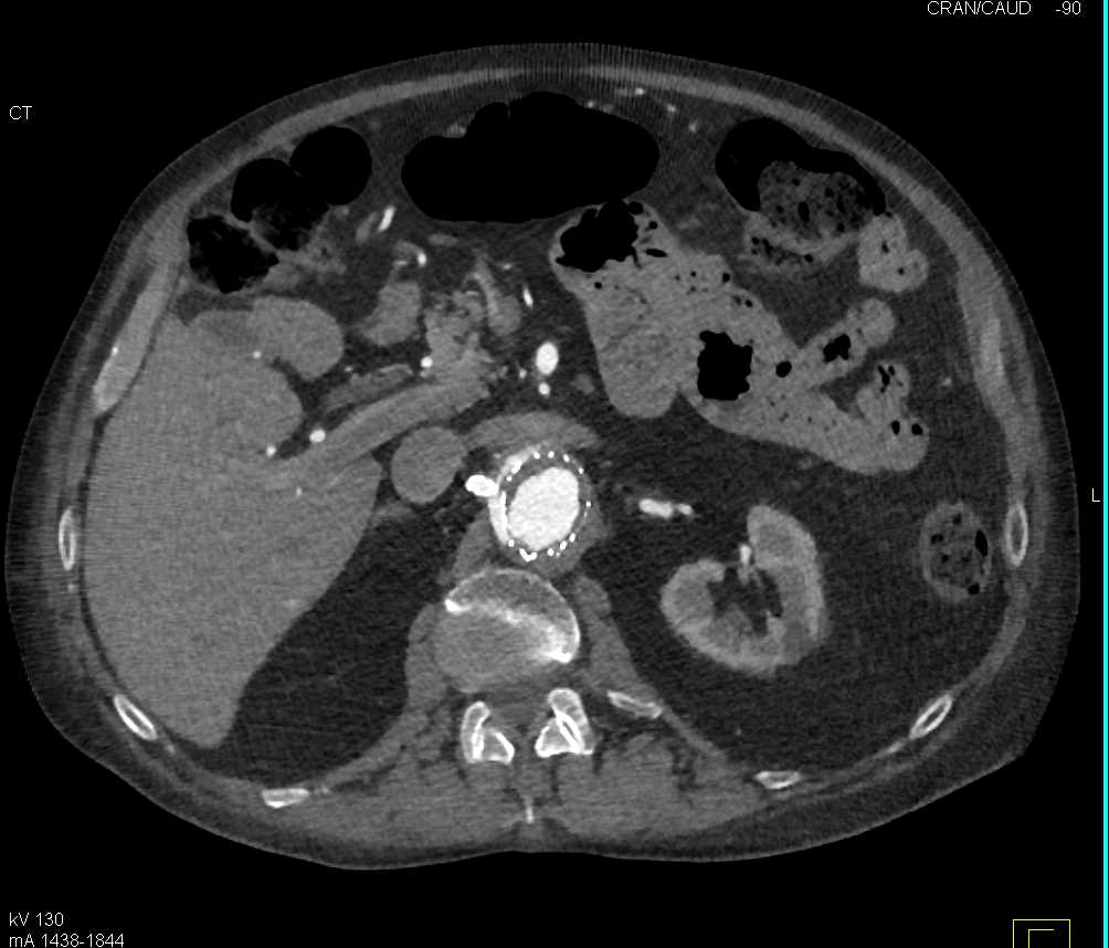 Endovascular Stent with Type 2 Endoleak - CTisus CT Scan