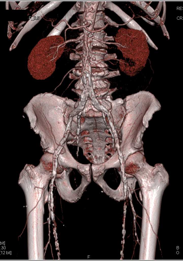 Extensive Peripheral Vascular Disease (PVD) - CTisus CT Scan