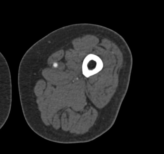 Peripheral Vascular Disease with Occluded Popliteal Artery - CTisus CT Scan