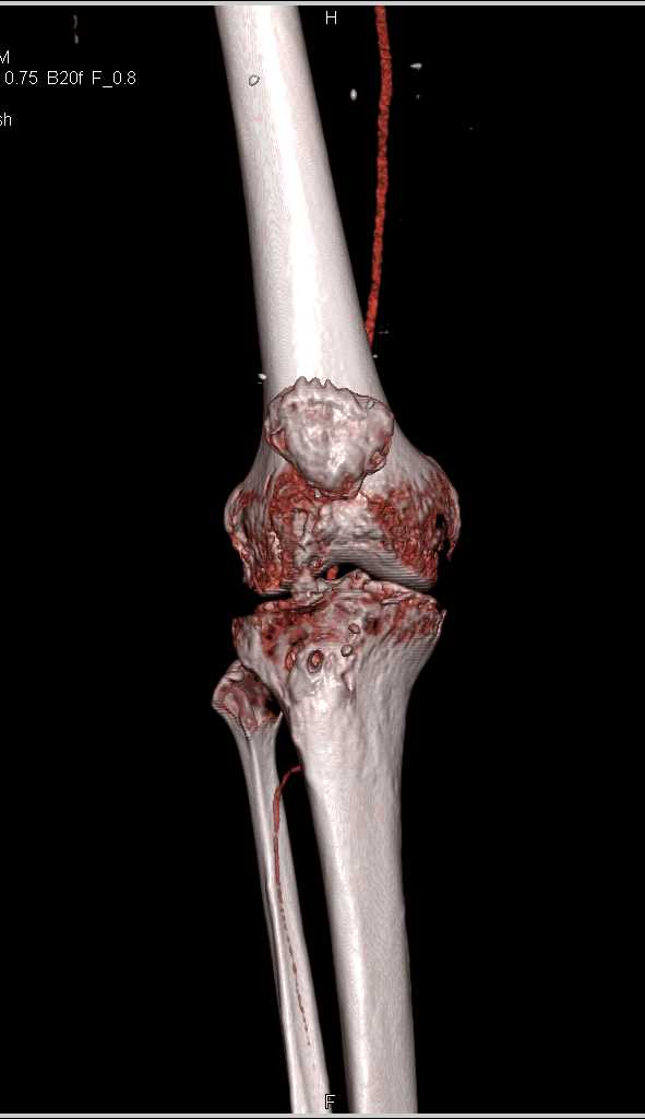 Intact Popliteal Artery - CTisus CT Scan
