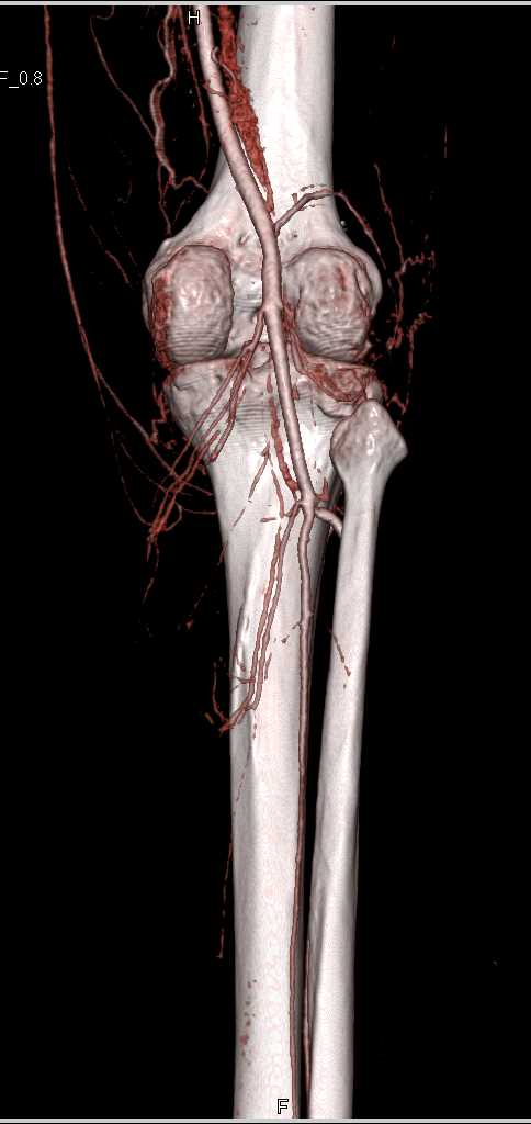 Intact Popliteal Artery - CTisus CT Scan