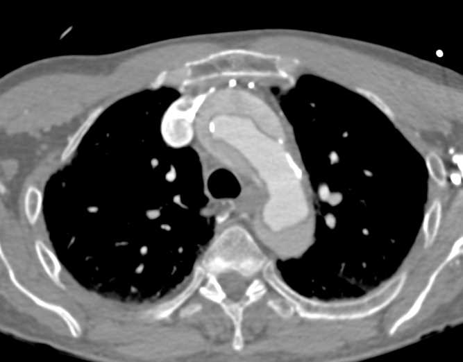 Aortic Type A Dissection - CTisus CT Scan