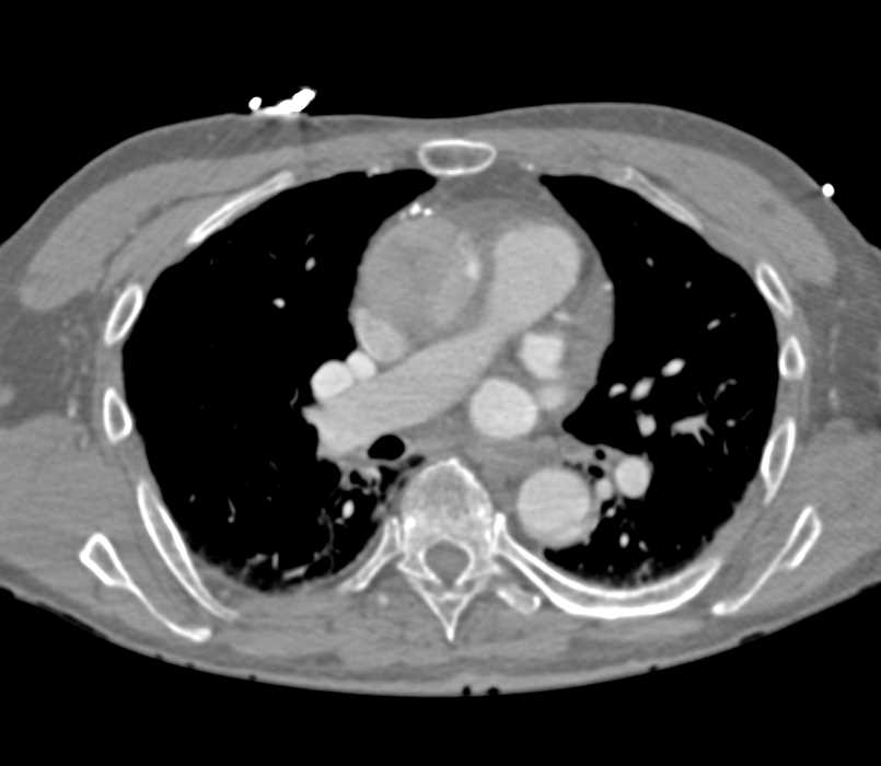 Aortic Type A Dissection - CTisus CT Scan