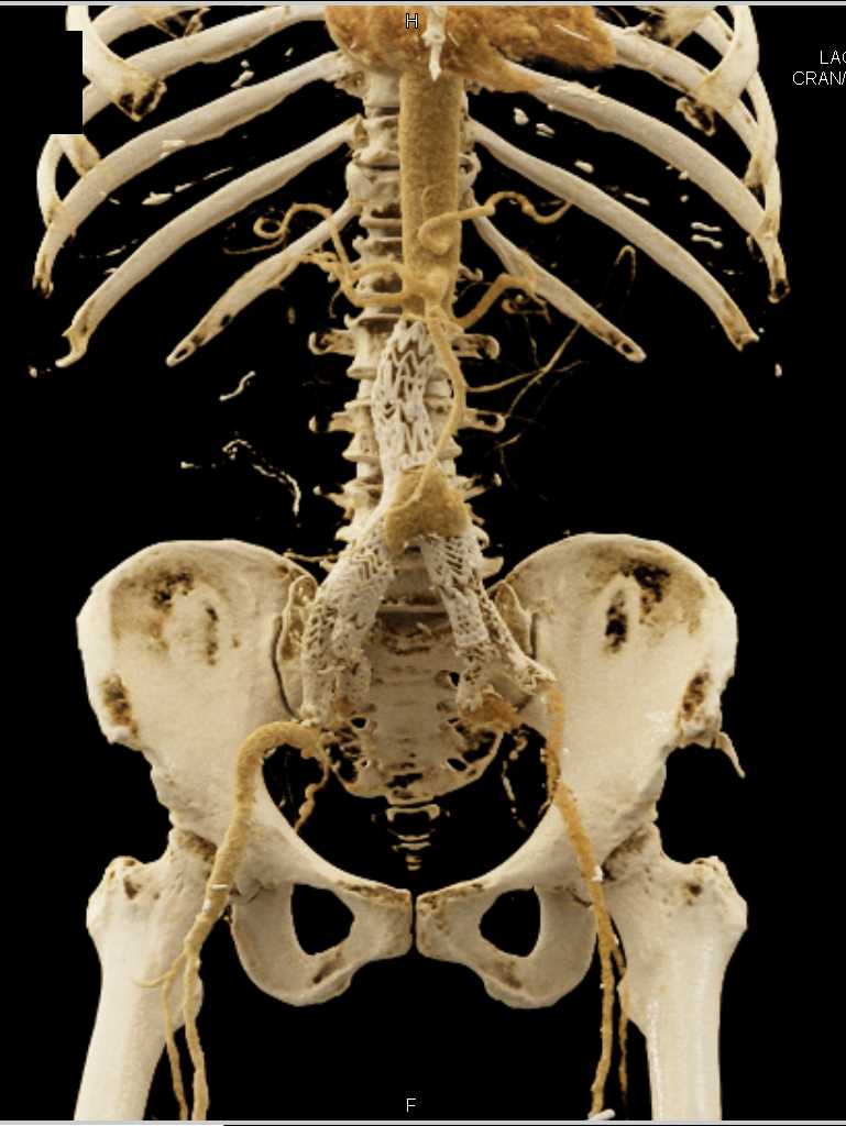 Endovascular Stent Repair - CTisus CT Scan