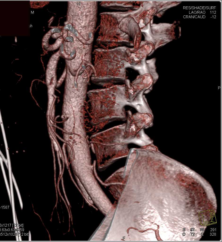 Superior Mesenteric Artery (SMA) Dissection - CTisus CT Scan