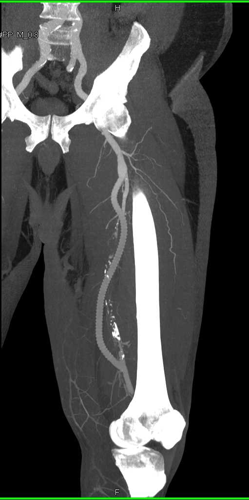 Fem-Popliteal Bypass Graft - CTisus CT Scan