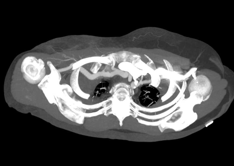 Patent Right Subclavian Artery Graft - CTisus CT Scan