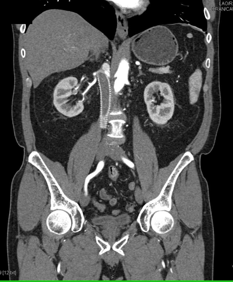 Inferior Vena Cava (IVC) Stent Repair - CTisus CT Scan