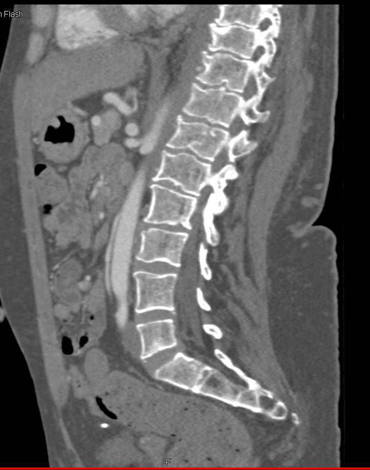 Patent Inferior Mesenteric Artery (IMA) - CTisus CT Scan