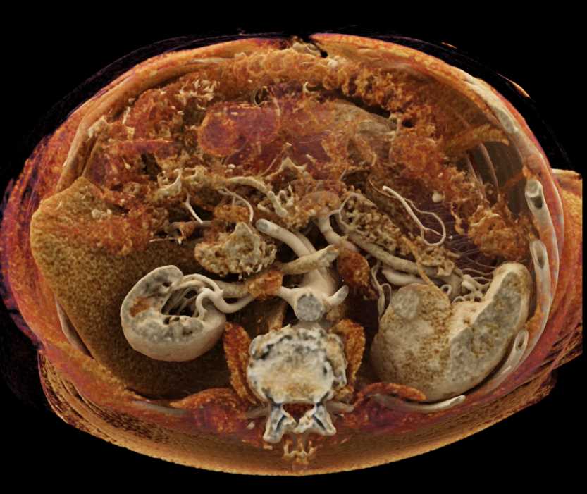 Mesenteric Arcade with Cinematic Rendering - CTisus CT Scan