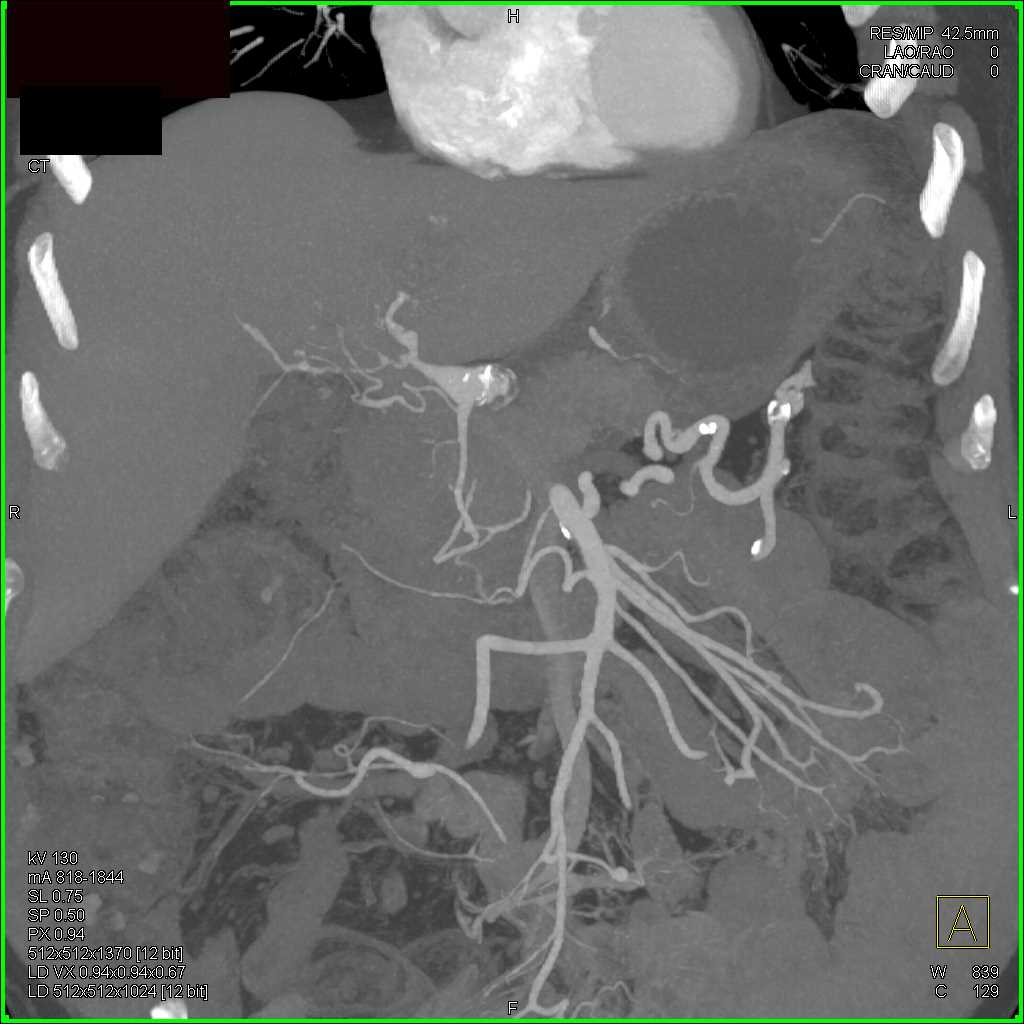 Hepatic Artery Aneurysm - CTisus CT Scan