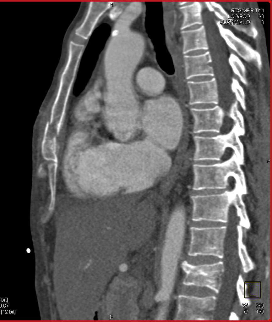 Motion Artifact at the Aortic Root Simulates Dissection - CTisus CT Scan