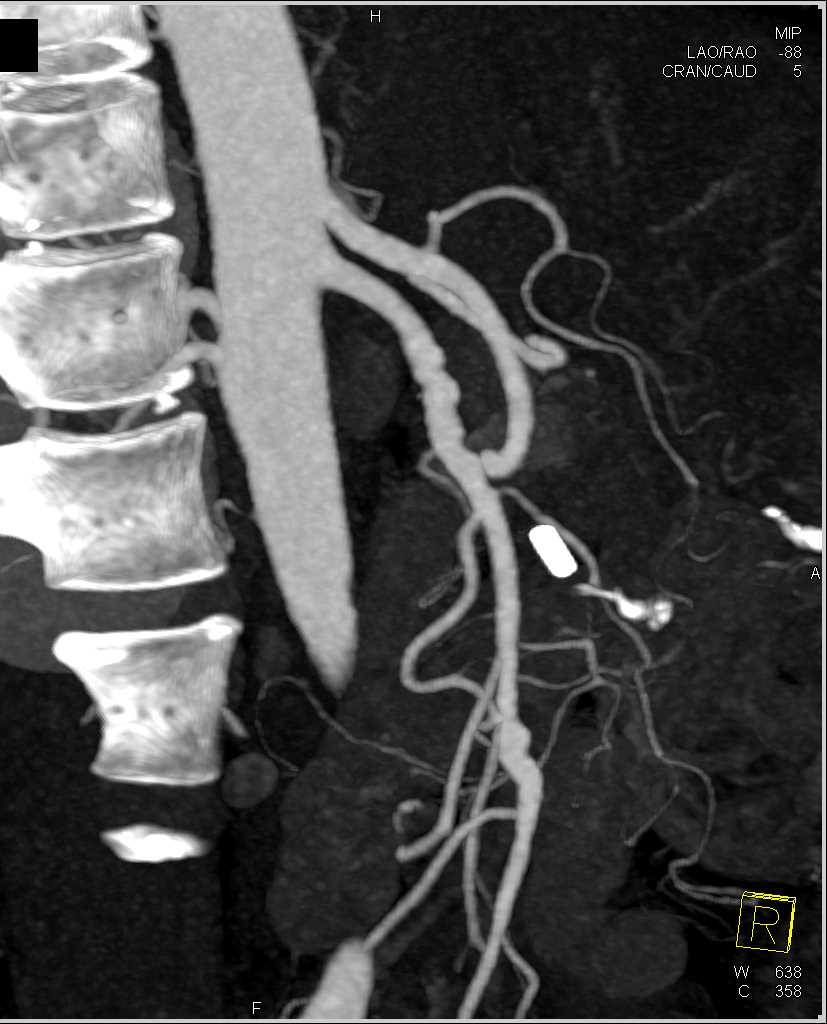 Fibromuscular Dysplasia (FMD) Involves the Superior Mesenteric Artery (SMA) and Splenic Artery - CTisus CT Scan