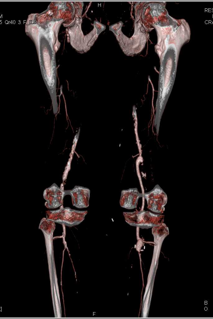 CTA Runoff with Peripheral Arterial Disease (PAD) - CTisus CT Scan