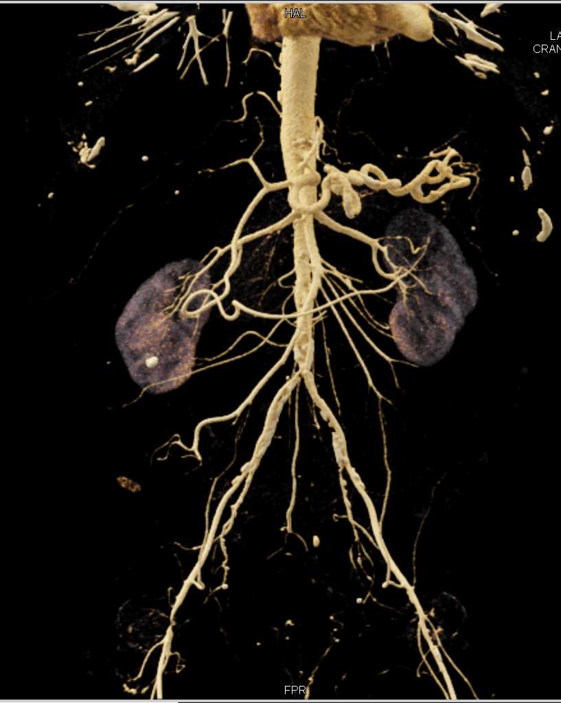 Peripheral Vascular Disease - CTisus CT Scan