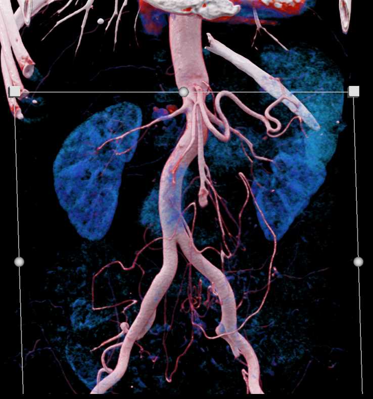 Superior Mesenteric Artery Aneurysm