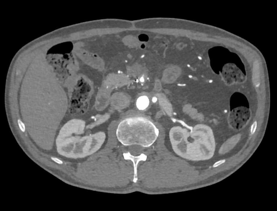 Aortic Aneurysm Repair with Vessel Re-Implantation - CTisus CT Scan