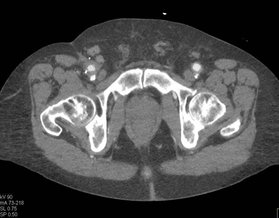 Extensive Bilateral Peripheral Arterial Disease - CTisus CT Scan